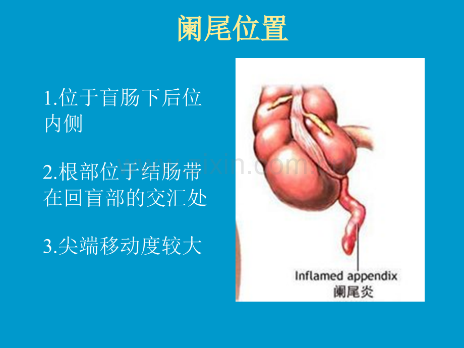 阑尾炎临床诊断医学PPT课件.ppt_第2页