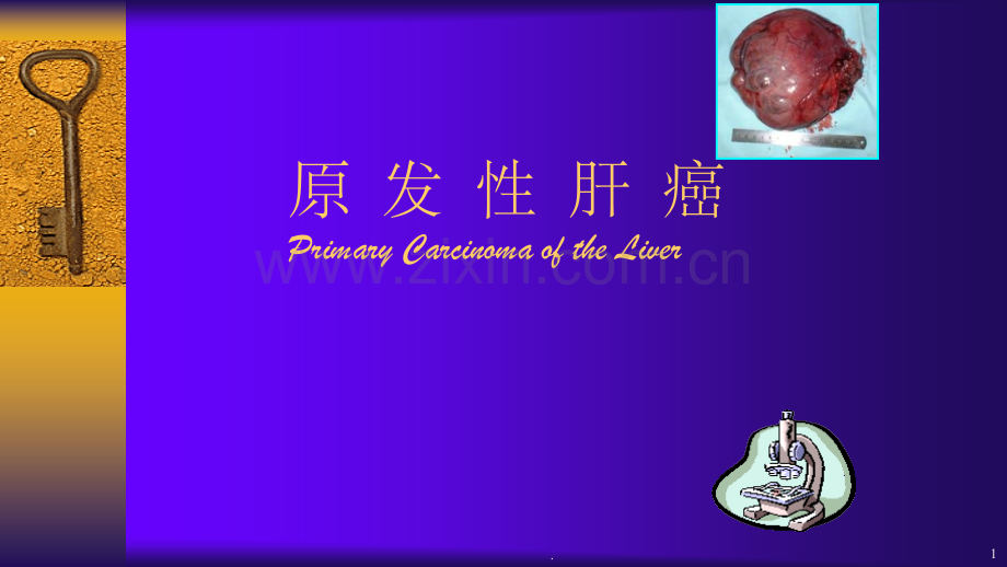 原发性肝癌.ppt_第1页