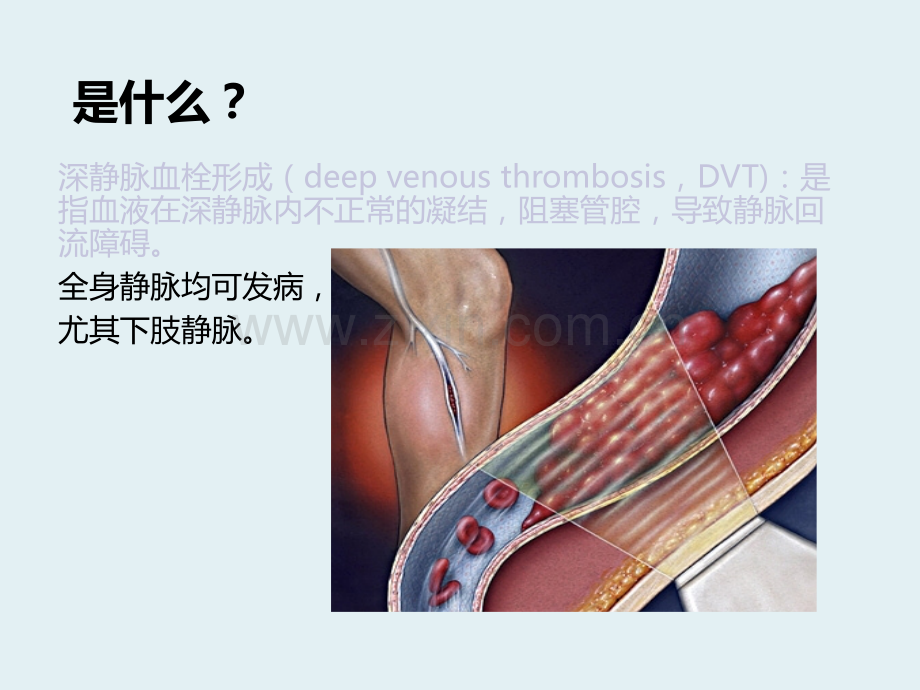 深静脉血栓健康宣教.ppt_第3页