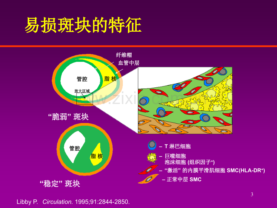 急性心肌梗死的治疗原则.ppt_第3页