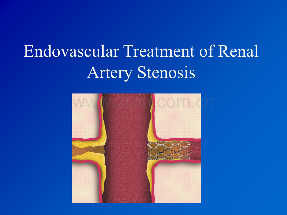肾动脉支架植入术图文详解.ppt_第1页
