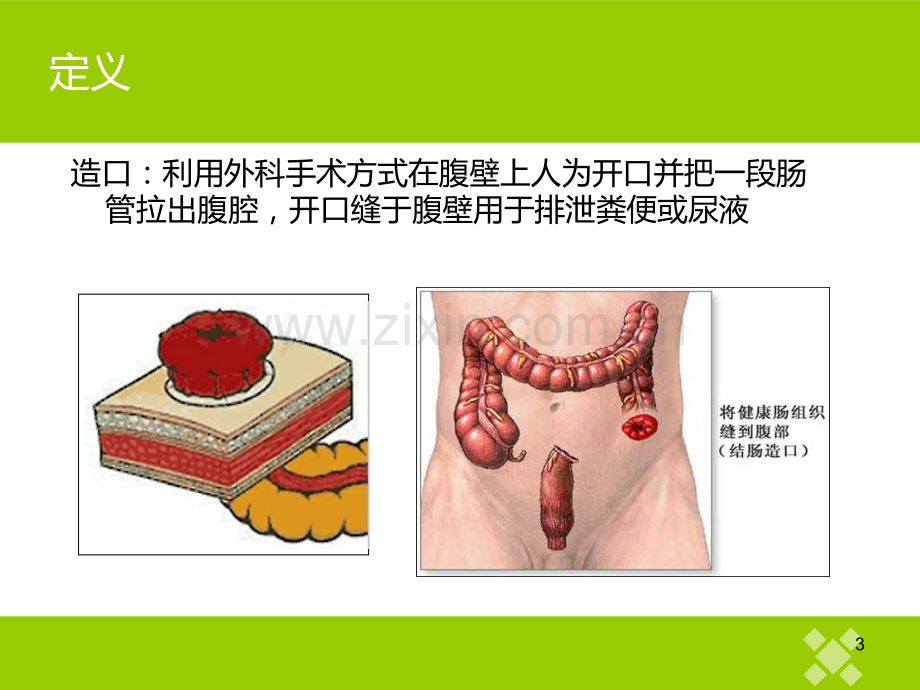 两种造口的差别.ppt_第3页