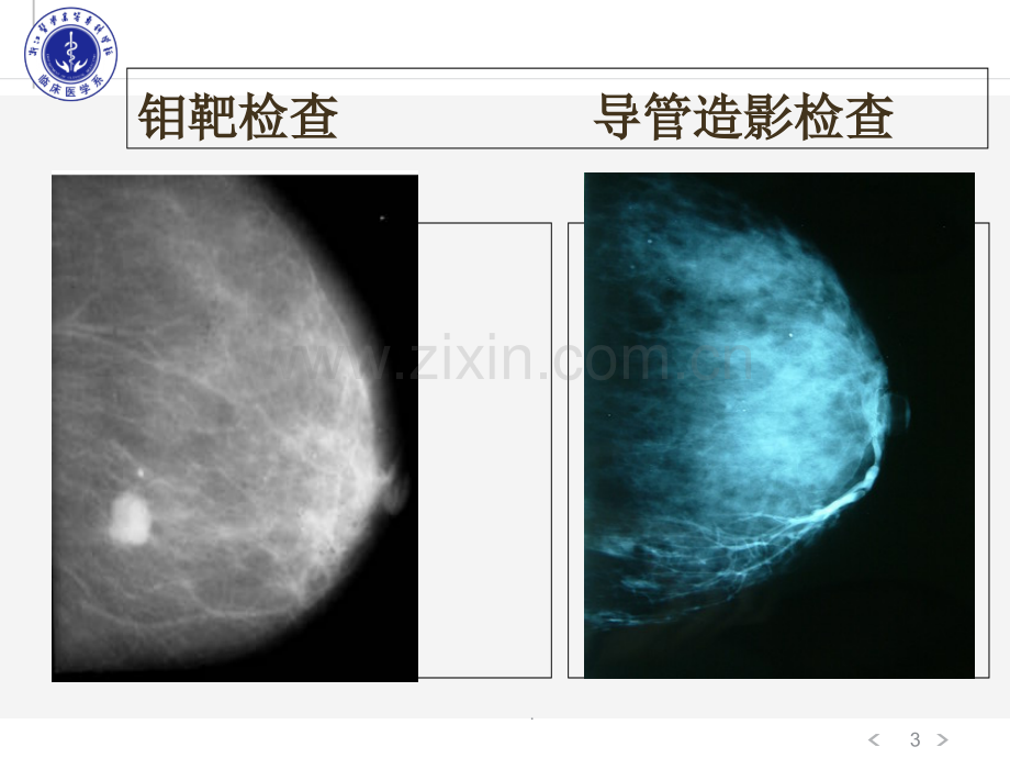 乳房疾病1.ppt_第3页