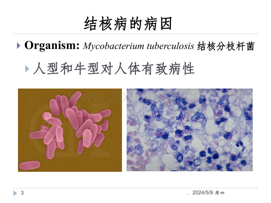 病理学--结核病.ppt_第3页