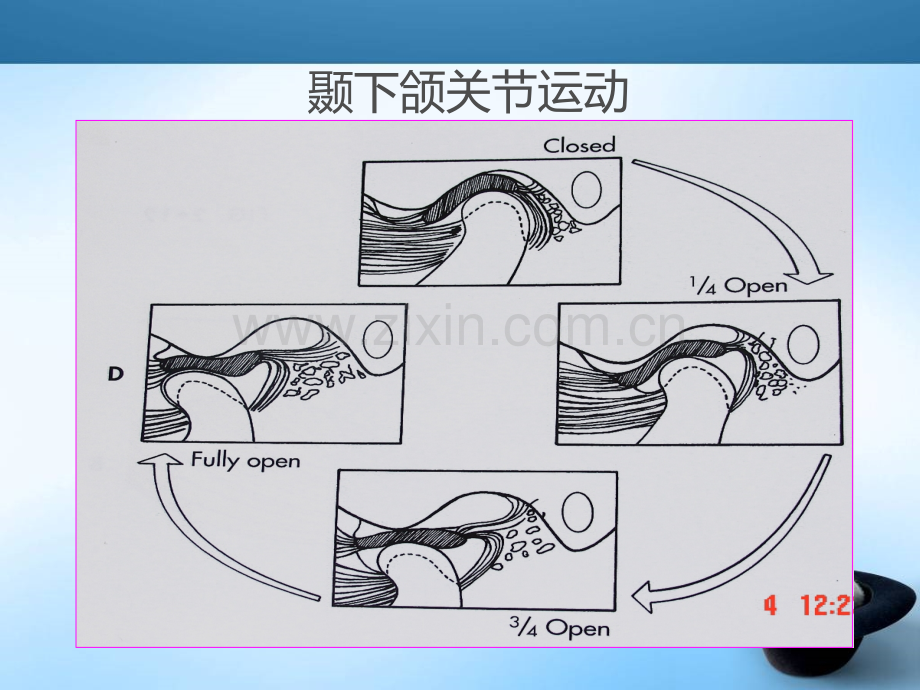 颞下颌关节紊乱MRI表现.ppt_第2页