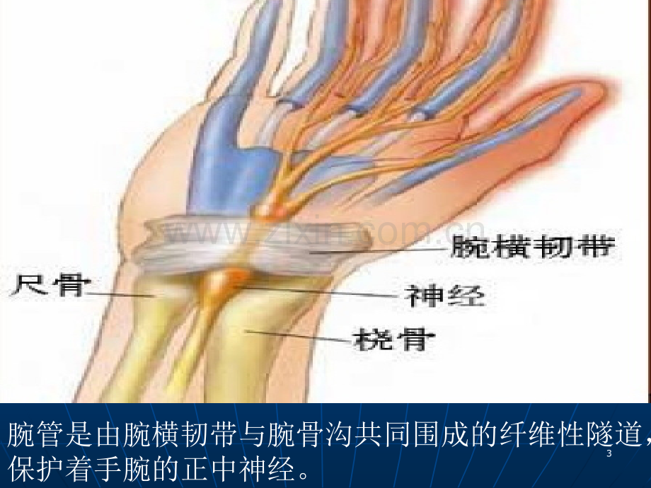 腕管综合征护理.ppt_第3页