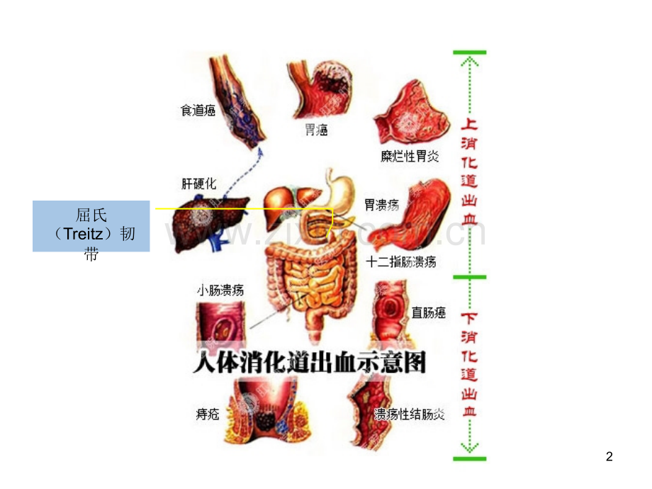 上下消化道出血鉴别.ppt_第2页