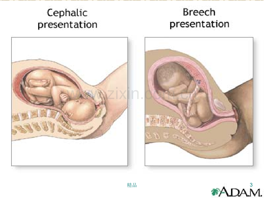 胎位异常.ppt_第3页