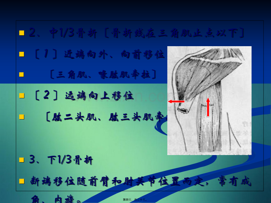 伤科肱骨干骨折.pptx_第3页