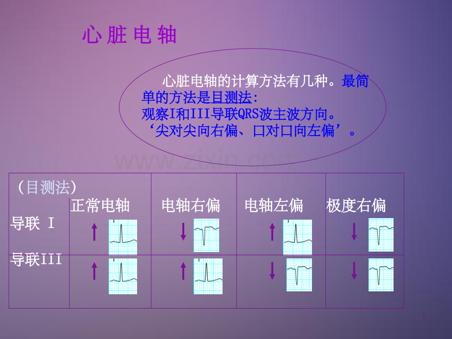 常见异常心电图.ppt_第2页