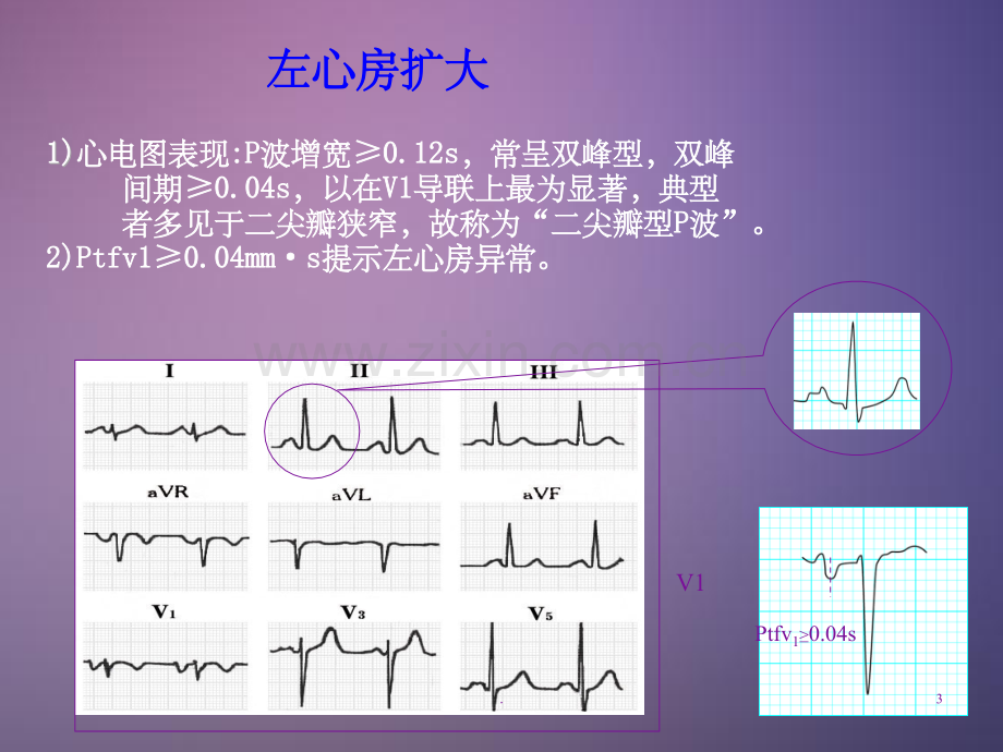 常见异常心电图.ppt_第3页