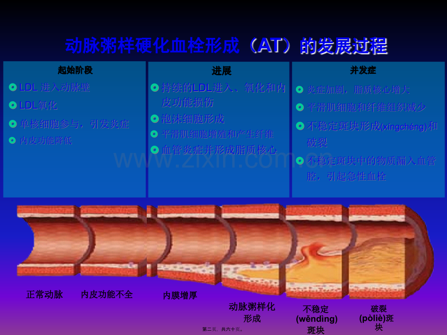 急性冠脉综合征的当代新理念(讲稿1.ppt_第2页