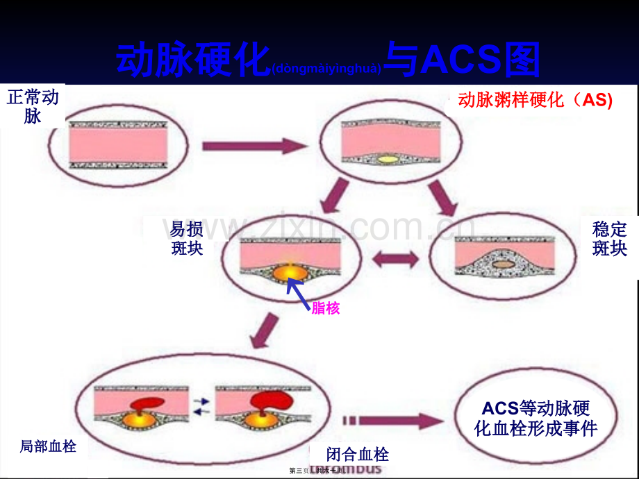 急性冠脉综合征的当代新理念(讲稿1.ppt_第3页