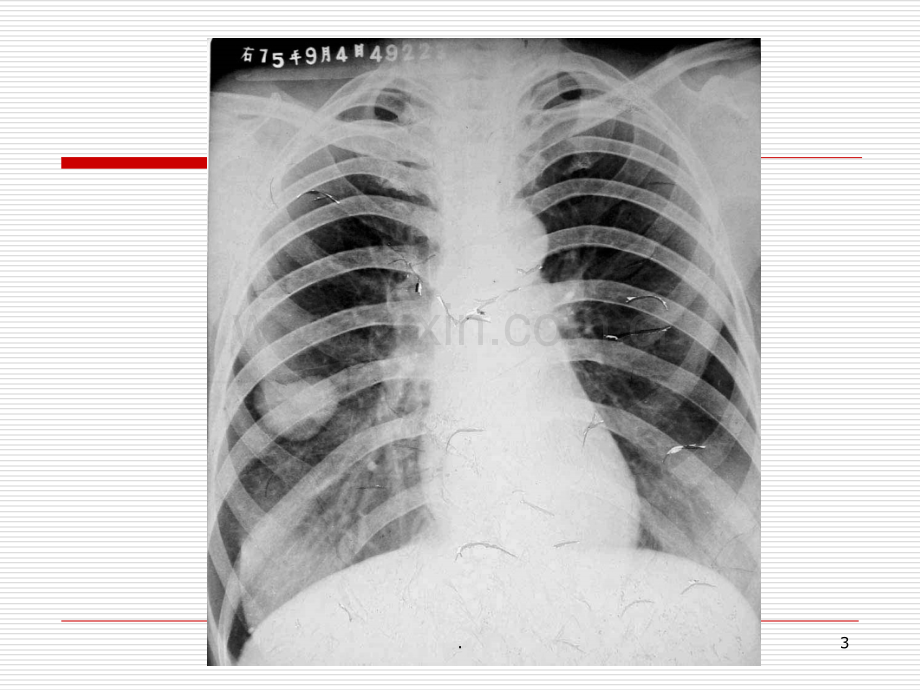 胸部CT影像诊断与鉴别诊断.ppt_第3页