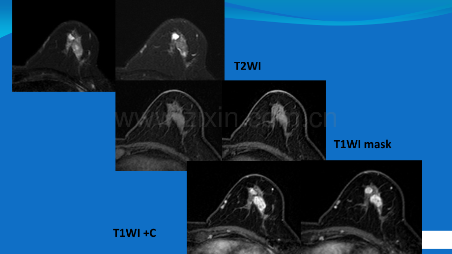 乳腺病变的MRI图像解读及BIRADS-分类-新疆.ppt_第2页