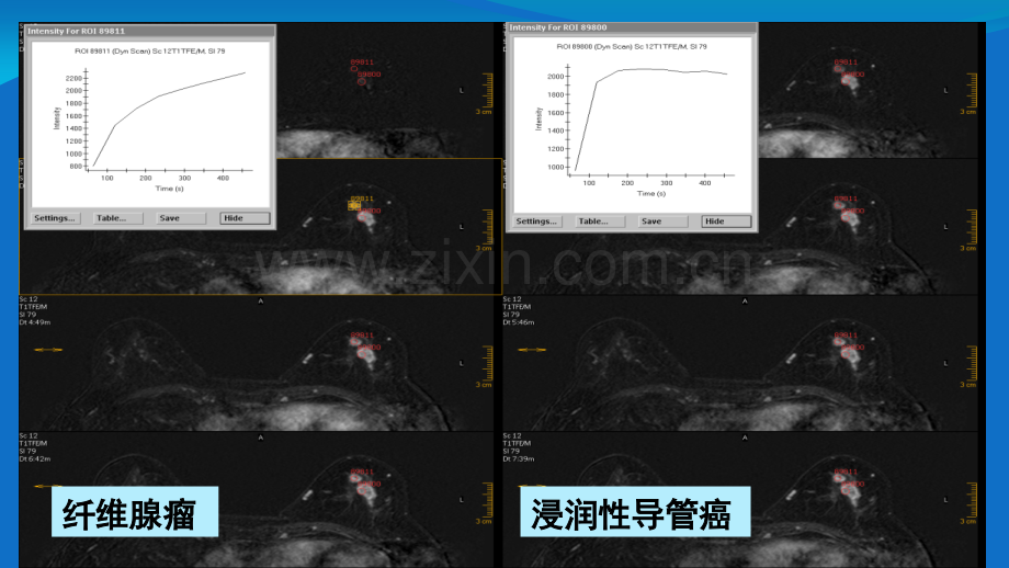 乳腺病变的MRI图像解读及BIRADS-分类-新疆.ppt_第3页