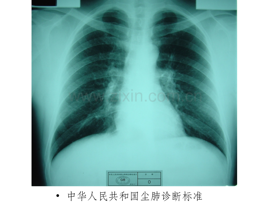 尘肺标准片.ppt_第2页