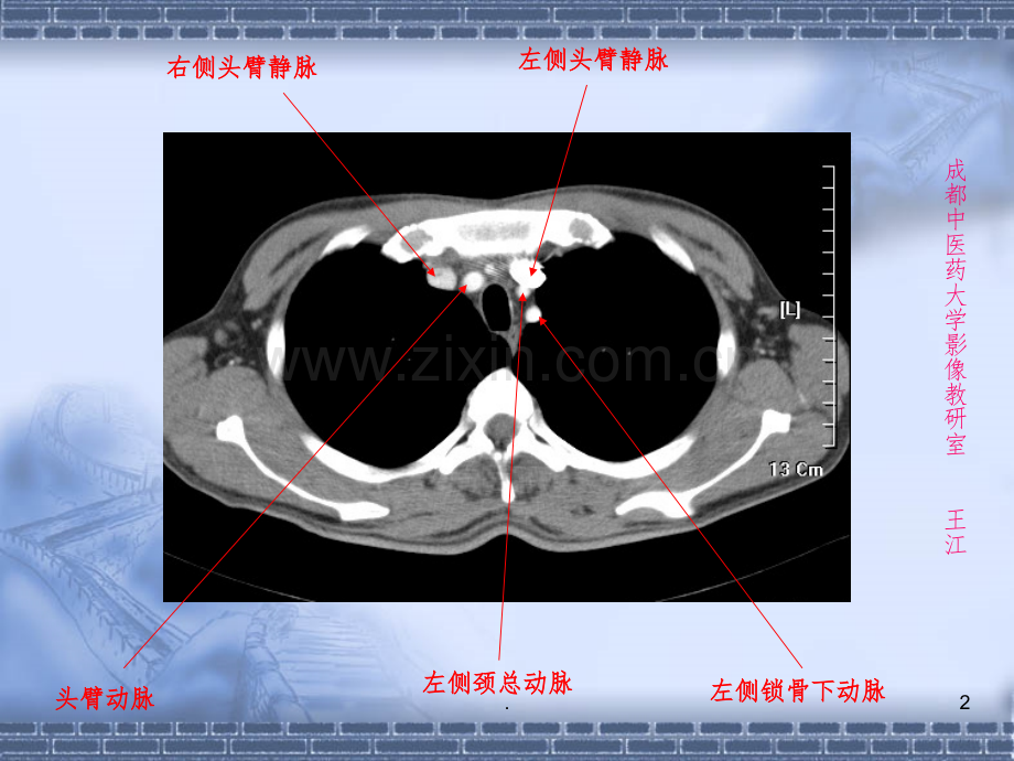 肺部CT-肺部纵隔窗.ppt_第2页