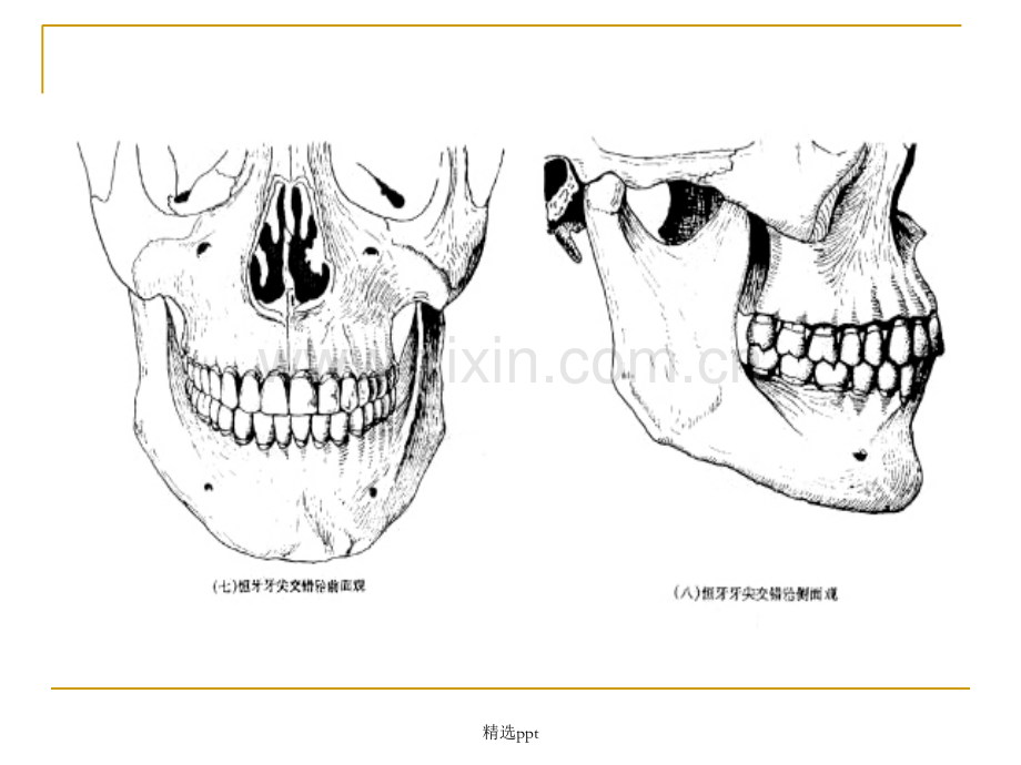 牙尖交错合2.ppt_第3页