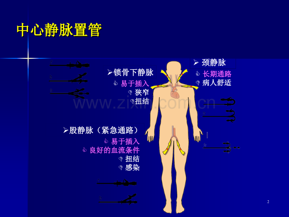 深静脉置管术.ppt_第2页