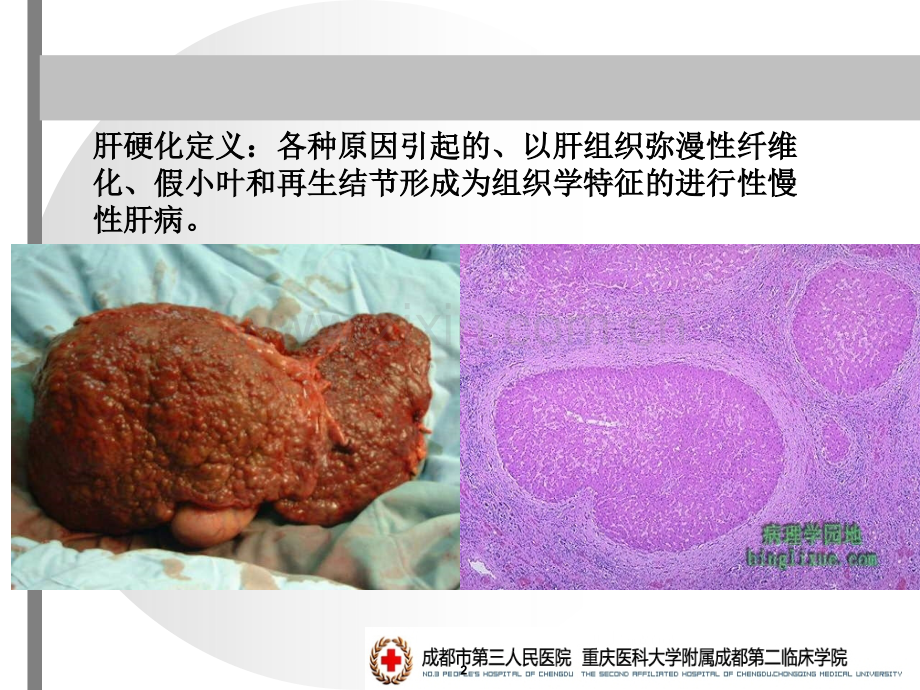 内科学-肝硬化.ppt_第2页