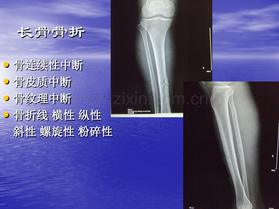 执业医师技能考试-X线、CT、B超--辅导(下).ppt_第2页