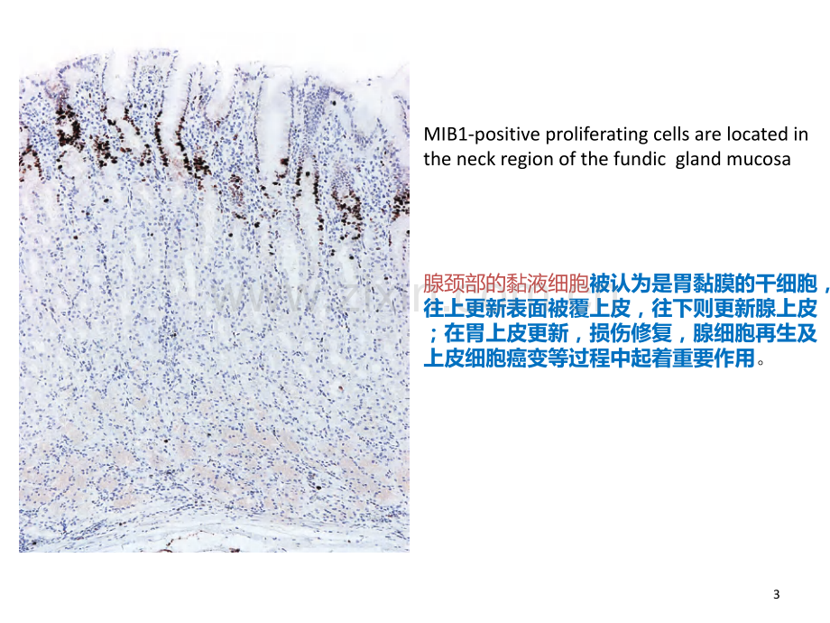 早期胃癌学习笔记.ppt_第3页