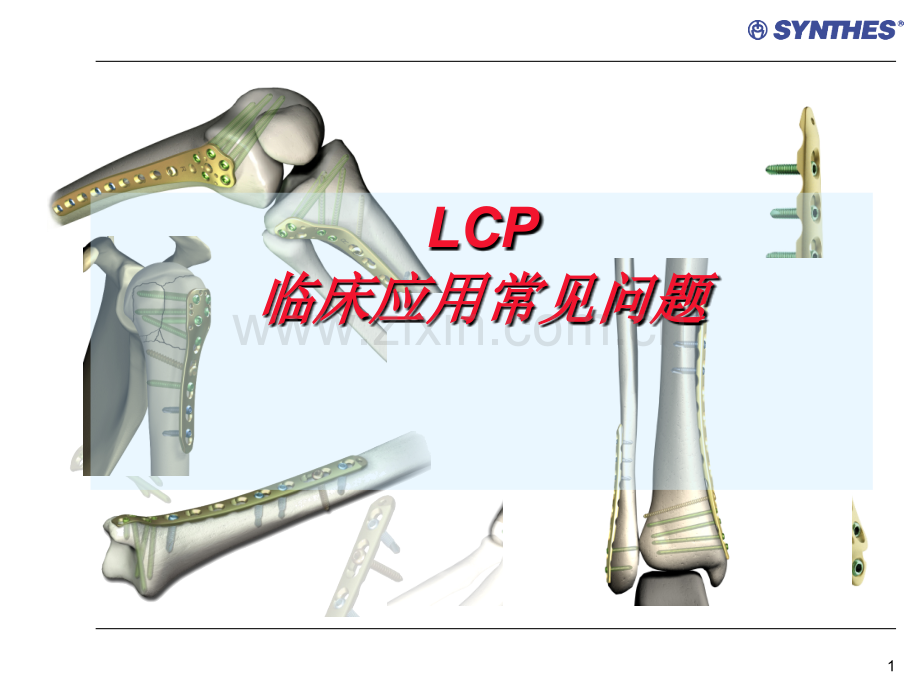 锁定内固定系统临床应用常见问题.ppt_第1页