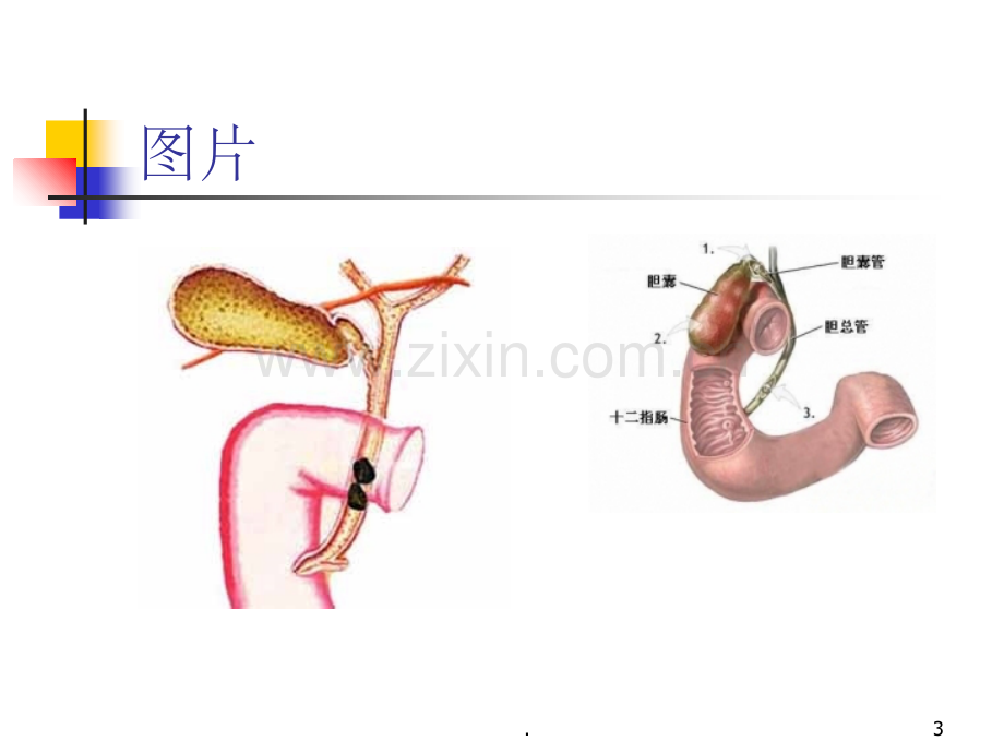 胆囊结石并胆囊炎--护理及饮食指导.ppt_第3页