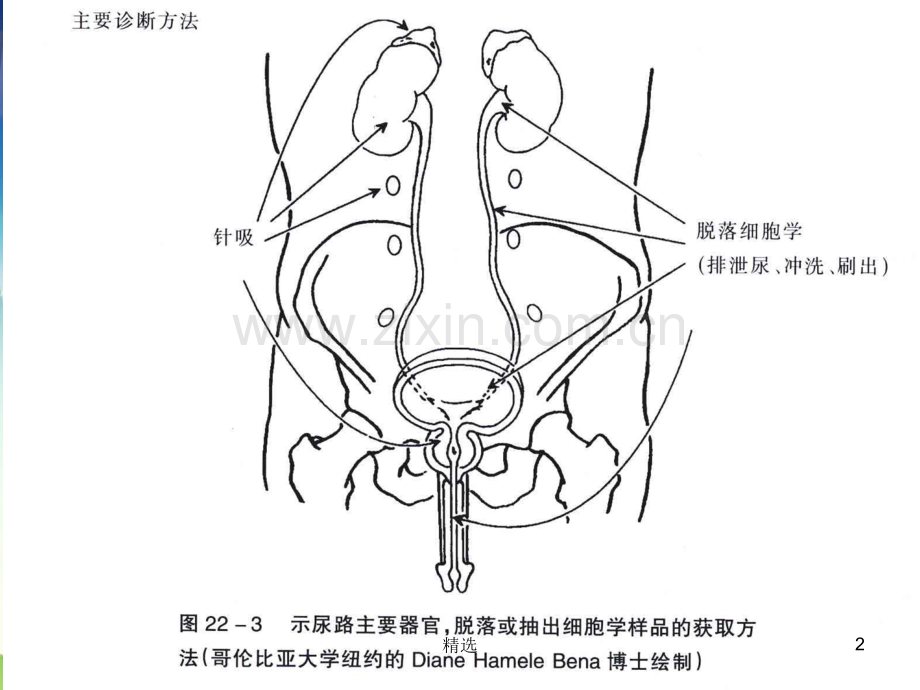 尿液脱落细胞的病理诊断.ppt_第2页