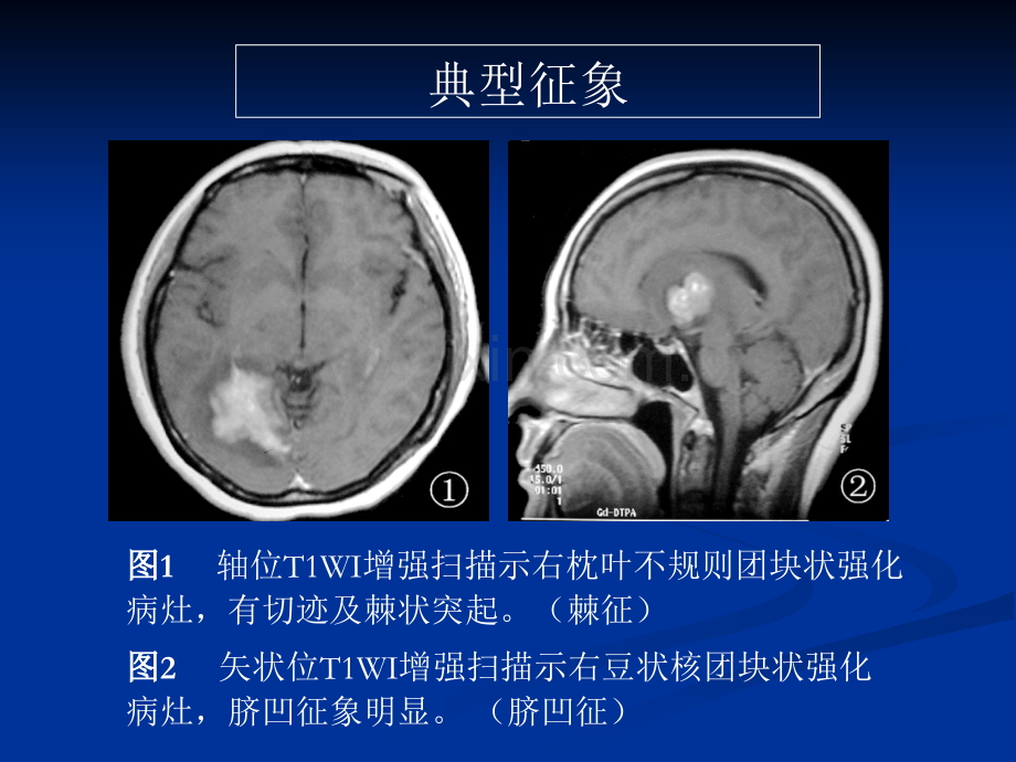 脑部原发性淋巴瘤的MRI诊断.ppt_第3页