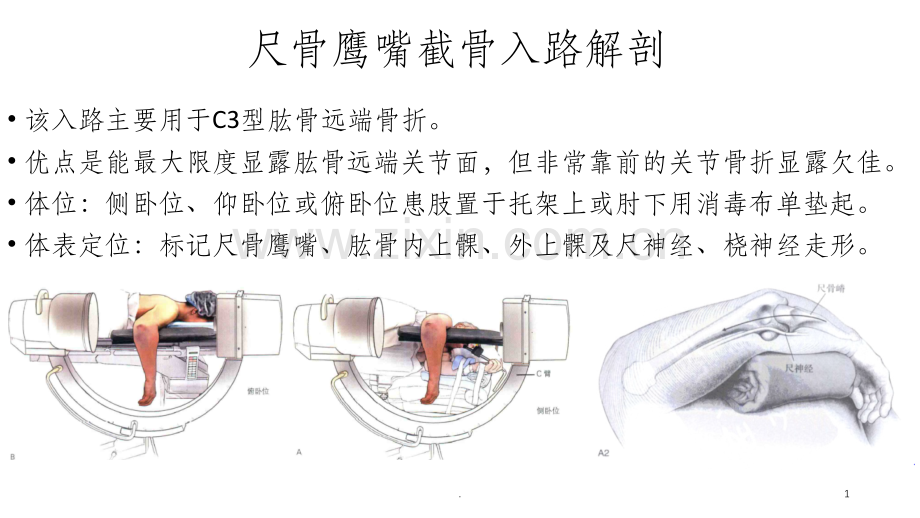 尺骨鹰嘴截骨入路解剖.ppt_第1页