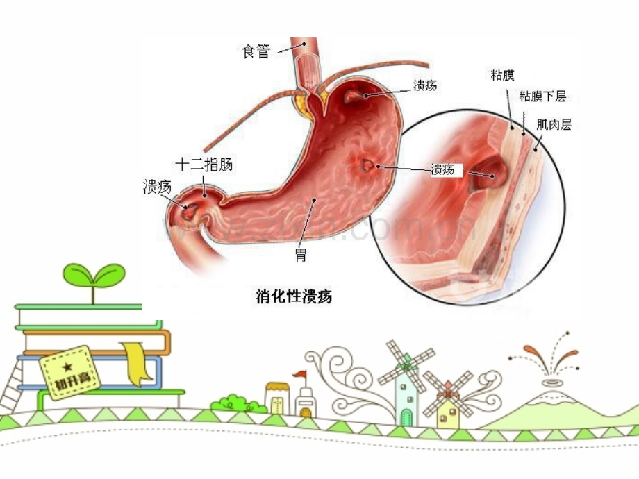 消化性溃疡的护理查房-.ppt_第3页