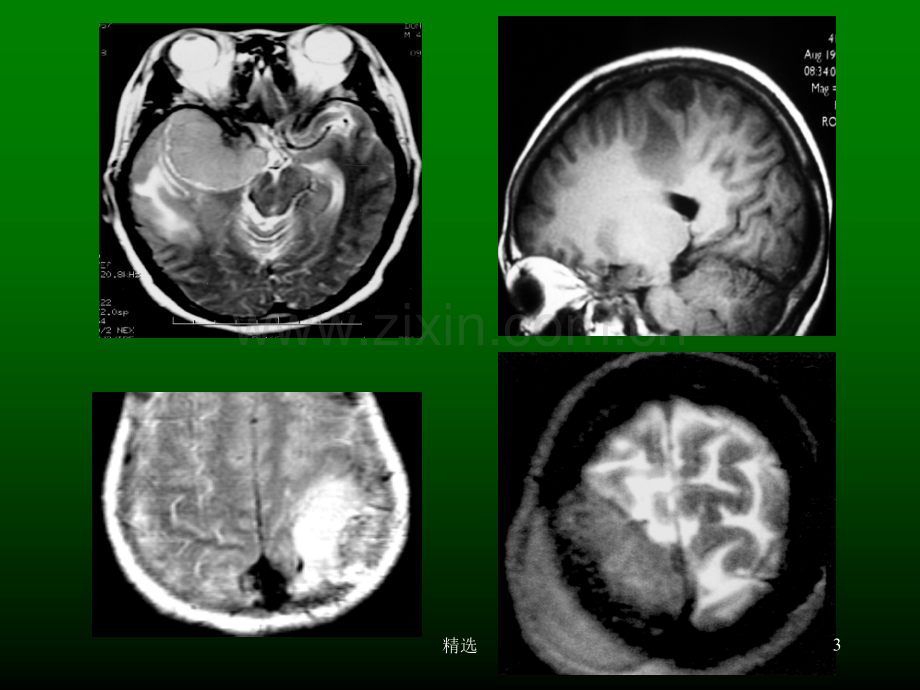 脑肿瘤的病理和影像学特征.ppt_第3页