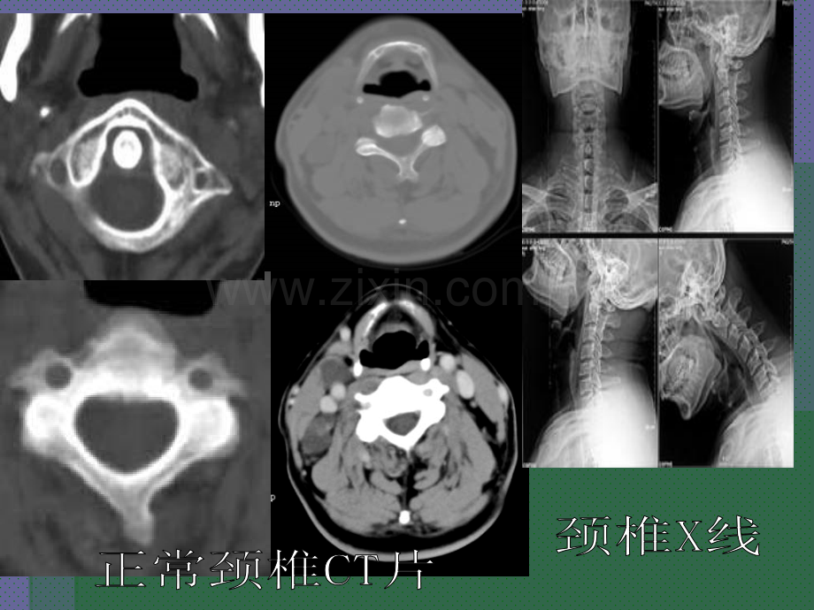 颈椎病-(2).ppt_第3页