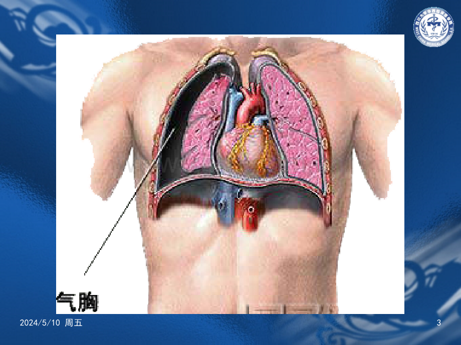 气胸的诊治.ppt_第3页