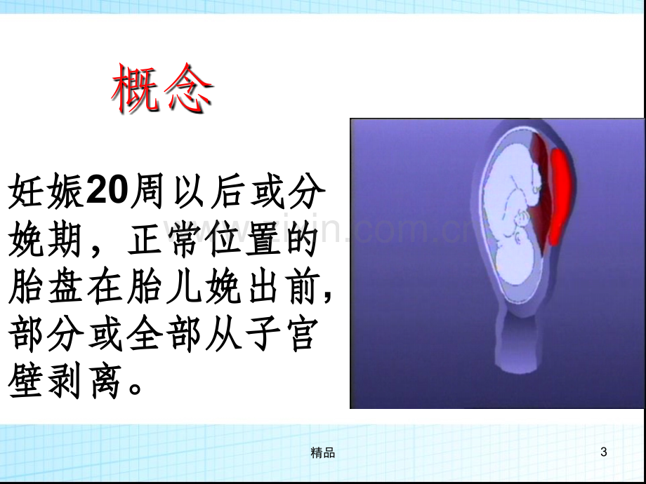 胎盘早剥的护理.ppt_第3页