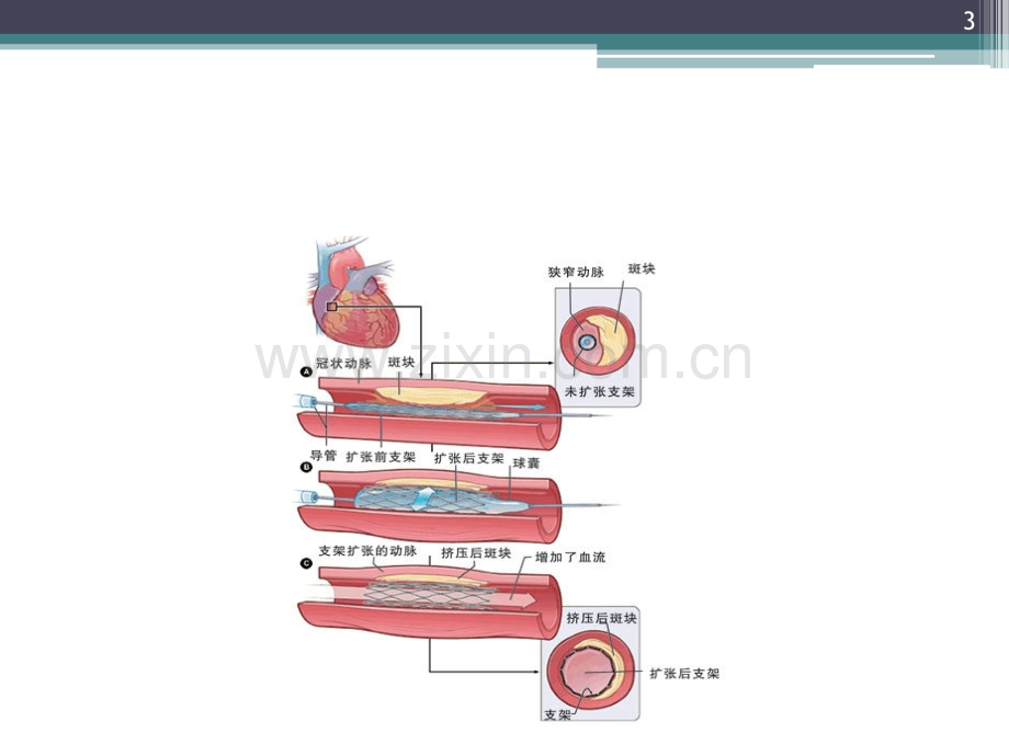 冠脉内溶栓临床应用.ppt_第3页