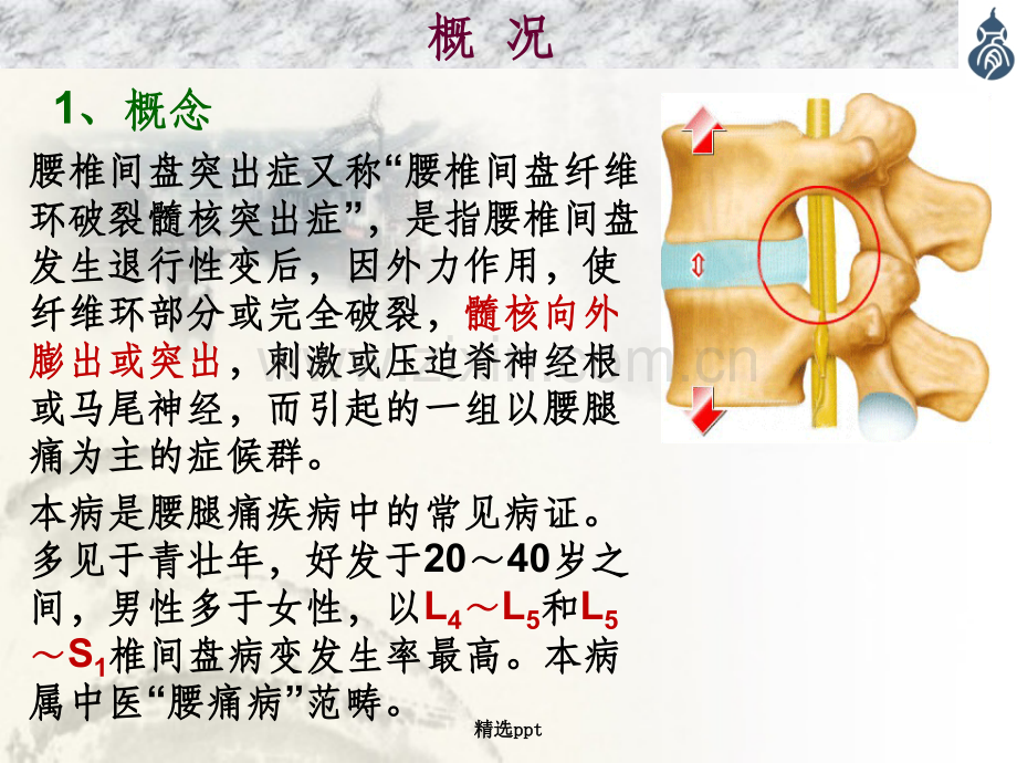 腰椎间盘突出症-内容(1).ppt_第3页