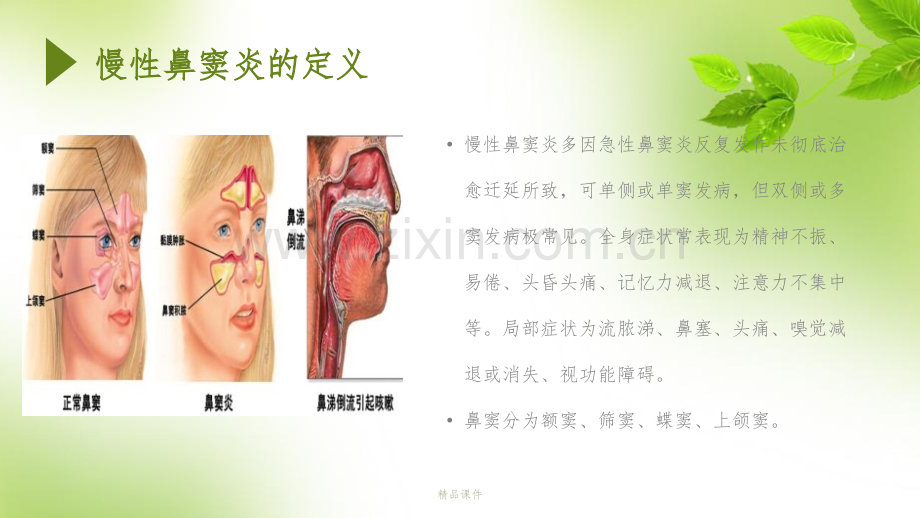 慢性鼻窦炎护理查房.pptx_第2页