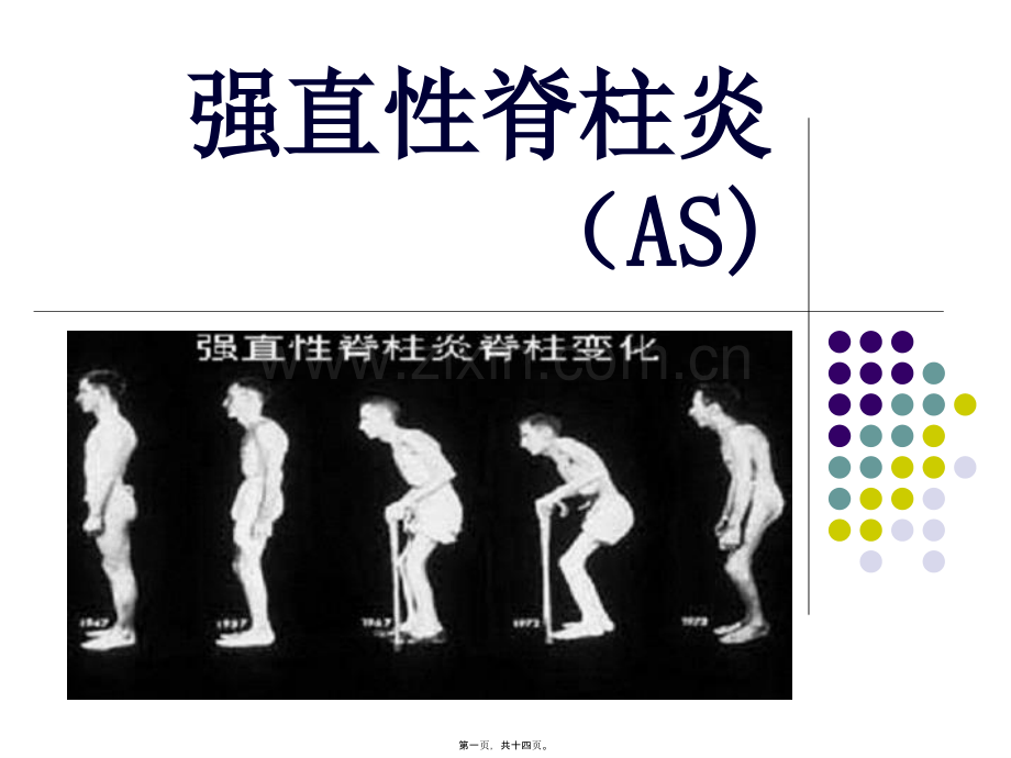 第06篇-强制性脊柱炎(AS.ppt_第1页