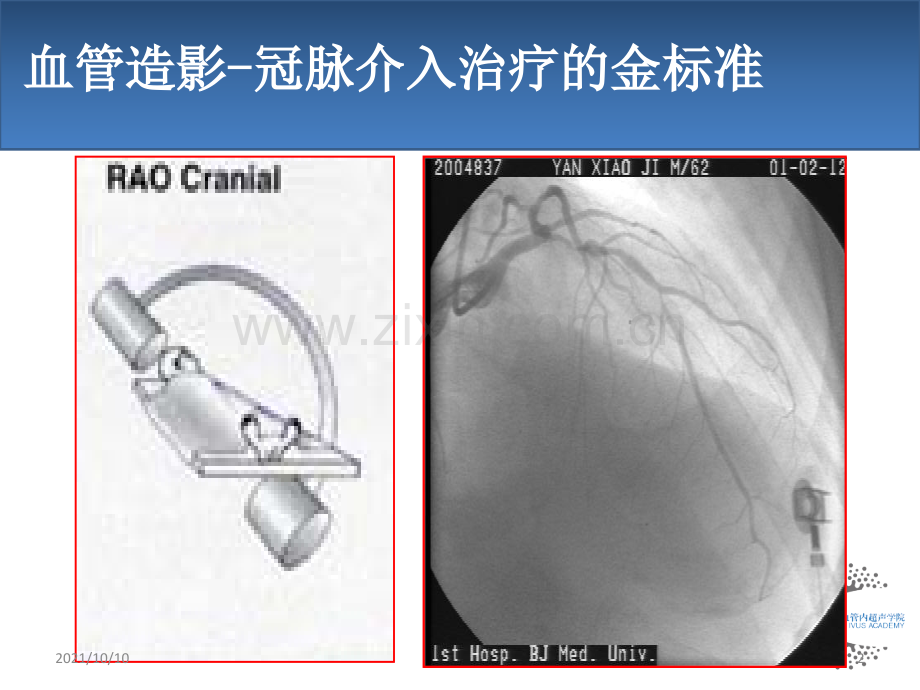 血管内超声IVUS原理和应用.ppt_第2页