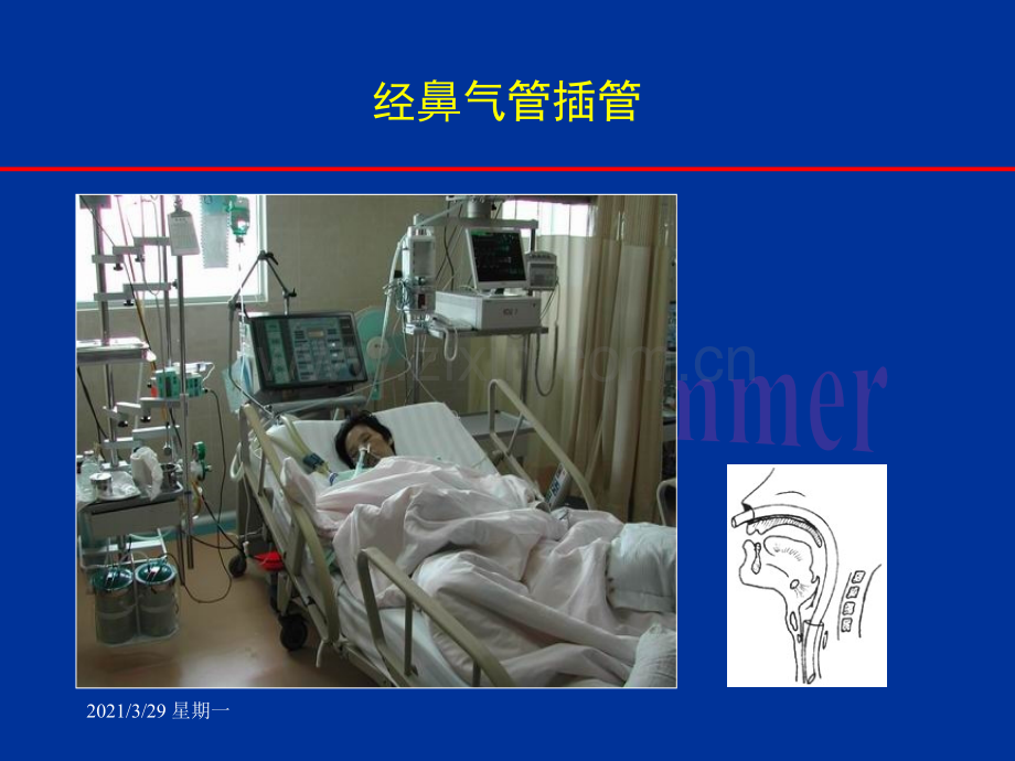 经鼻气管插管(NTI).ppt_第3页