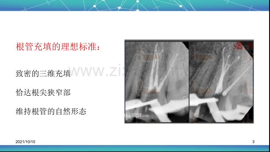 根管治疗术(五)：根管充填.ppt_第3页