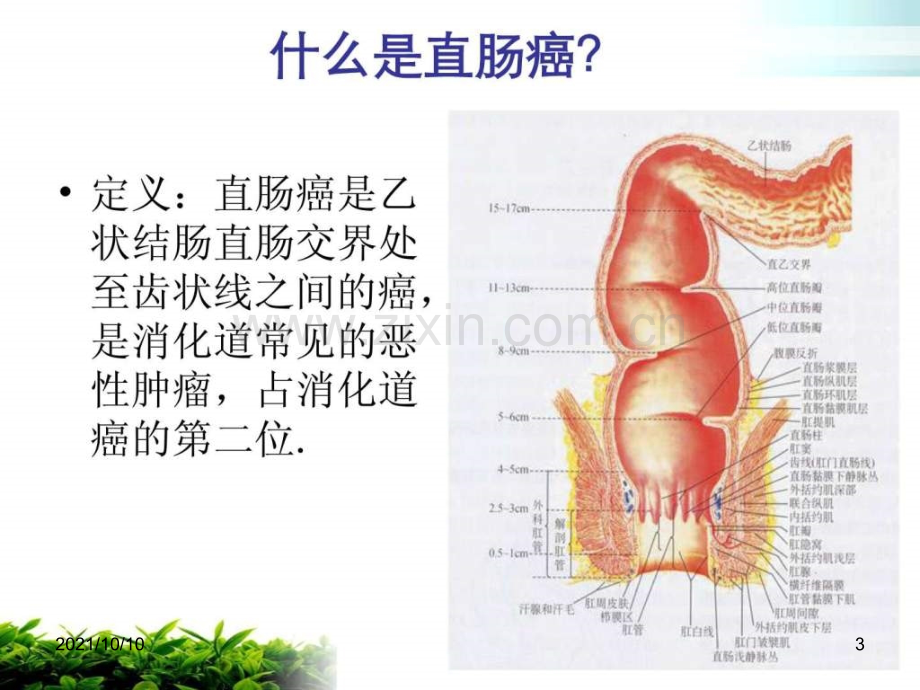 直肠癌-护理查房.ppt_第3页