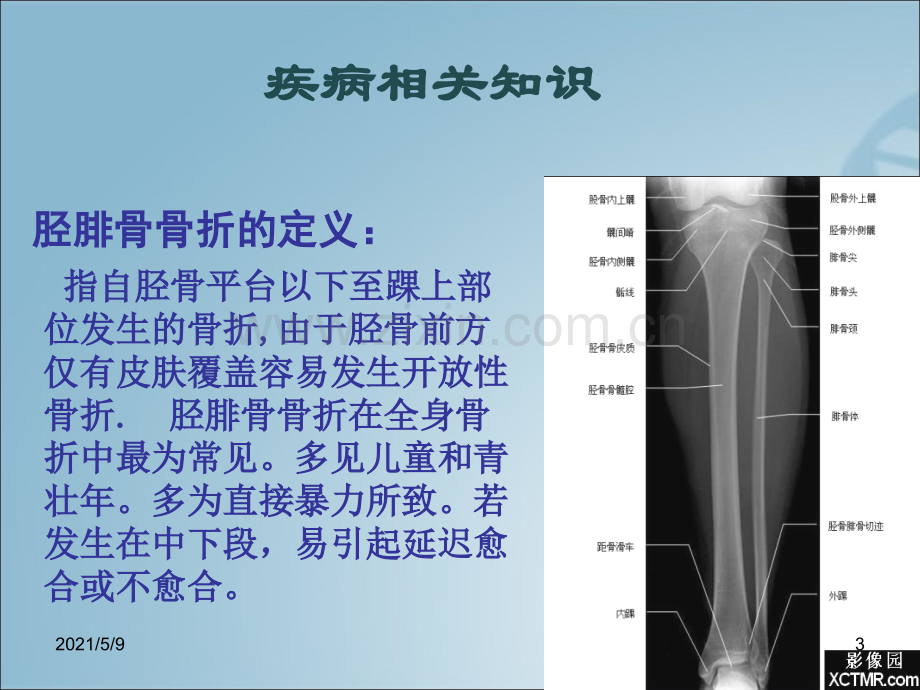 胫腓骨骨折的护理查房.ppt_第3页