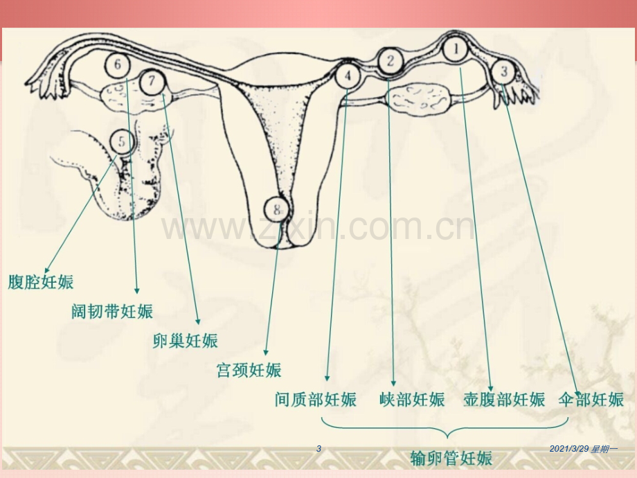 异位妊娠护理查房09534.ppt_第3页