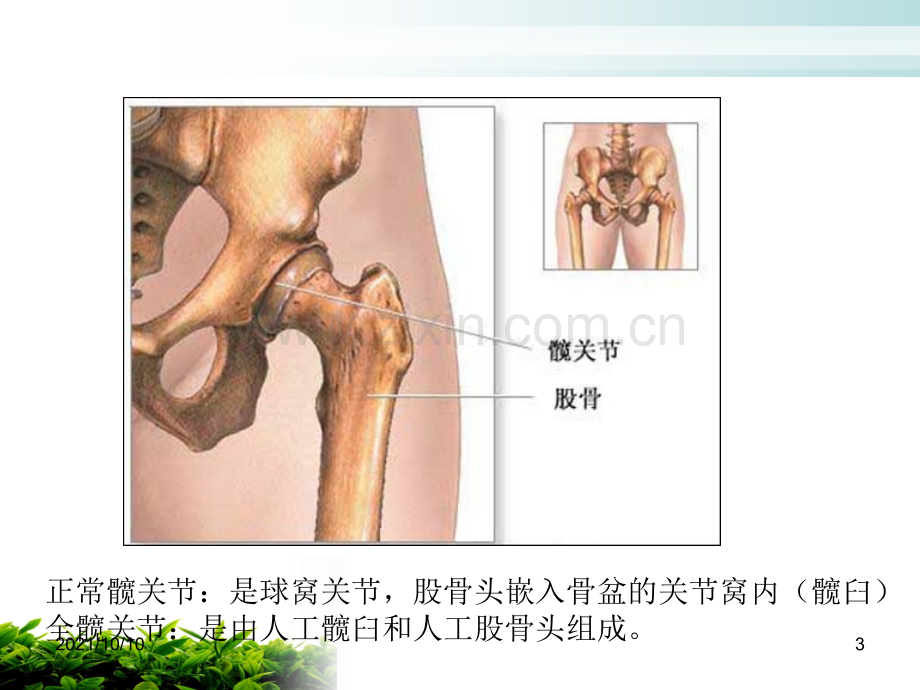 全髋关节置换术后的护理-课件(演示).ppt_第3页