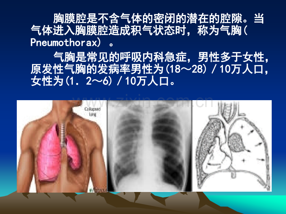 自发性气胸.ppt_第2页