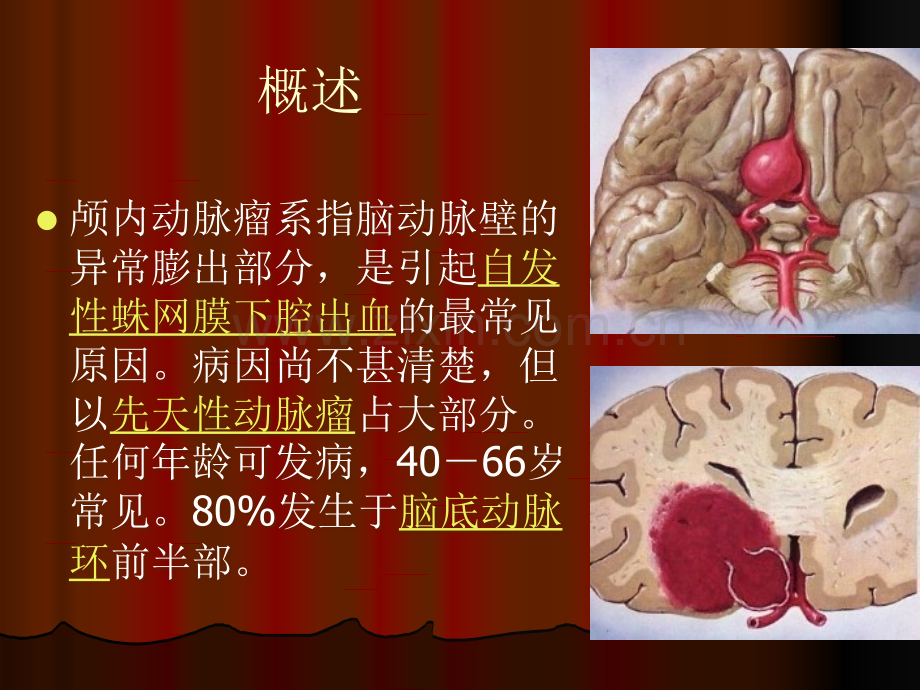 颅内动脉瘤.ppt_第2页